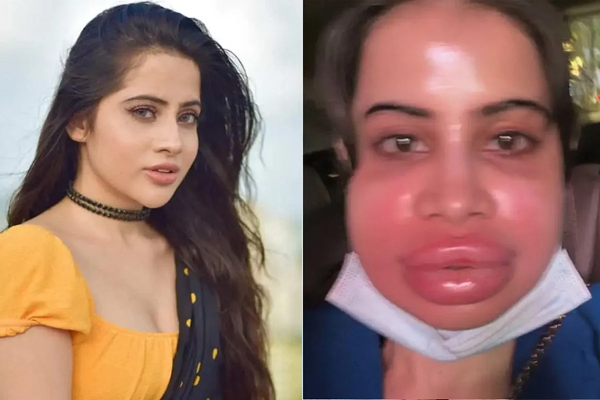 ঠোঁট ফুলে বেহাল উরফি, ইনস্টায় শেয়ার করলেন কষ্টের ভিডিও