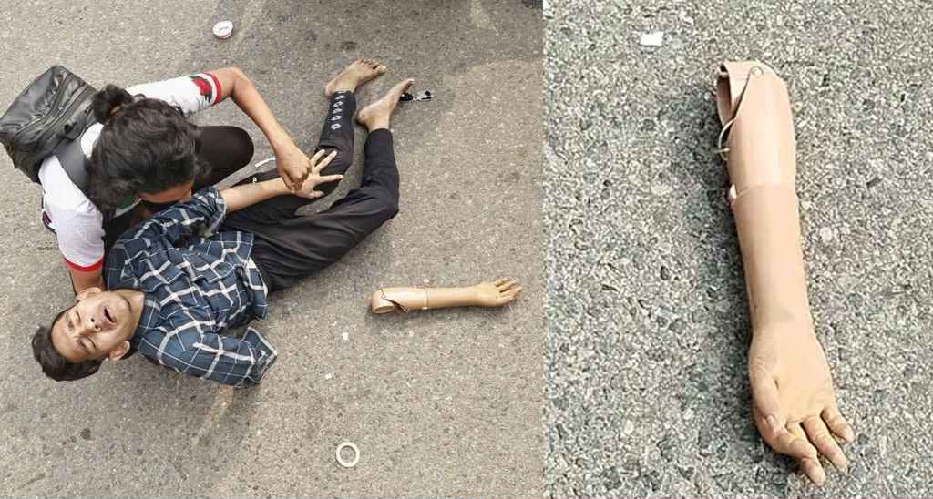 পুলিশের লাঠিচার্জ: রাস্তায় পড়েছিল জুলাই যোদ্ধার কৃত্রিম হাত