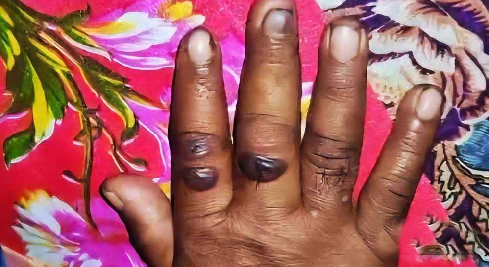 অ্যানথ্রাক্সের উপসর্গ নিয়ে নারীর মৃত্যু