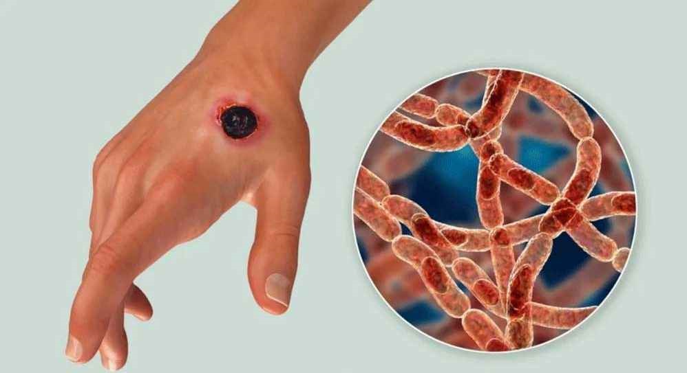 রংপুরের আরেক উপজেলায় অ্যানথ্রাক্স উপসর্গের ৬ রোগী