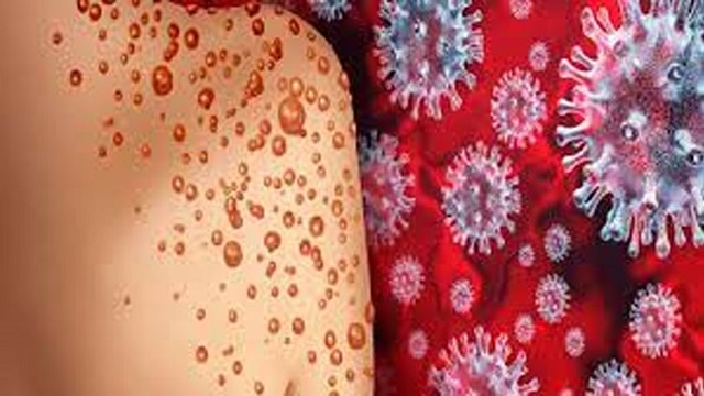 প্রথমবারের মতো একইসঙ্গে করোনা,মাঙ্কিপক্স ও এইডসে আক্রান্ত!
