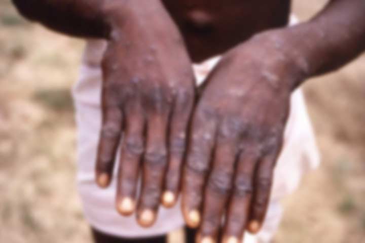 দেশে মাঙ্কিপক্সে আক্রান্ত কোনো রোগী নেই : বিএসএমএমইউ