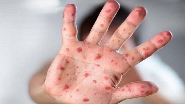 পাল্টে গেল মাঙ্কিপক্সের নাম