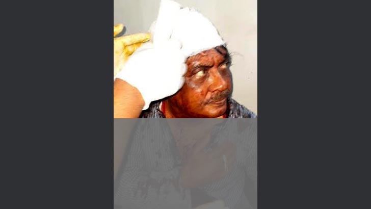 হামলায় রক্তাক্ত  বিএনপির বরকত উল্লাহ বুলু, স্ত্রীসহ আহত ৬